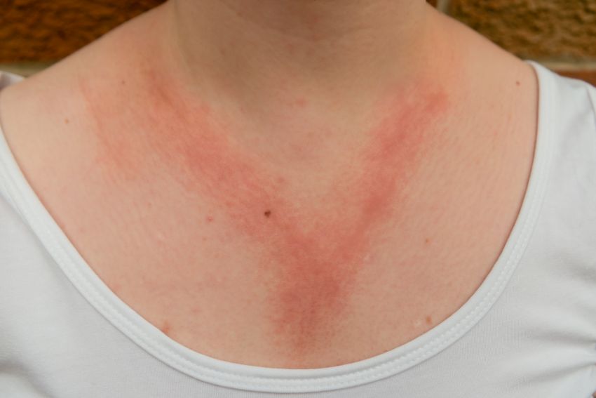 Dame mit allergischer Kontaktdermatitis, rotem Ausschlag an Brust und Hals als Reaktion auf eine Halskette. Vermutlich Nickelallergie.